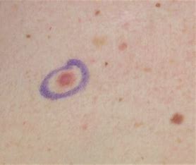 Melanoma: Understanding the Most Serious Type of Skin Cancer