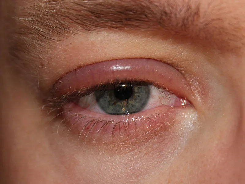 Blepharitis: Understanding Causes, Symptoms, and Treatments