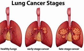 Stage 1 Lung Cancer Symptoms: Early Detection and Warning Signs