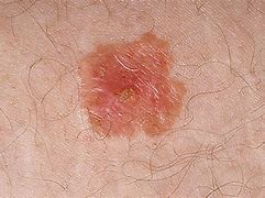Identifying Skin Cancer Symptoms: Early Detection and Awareness